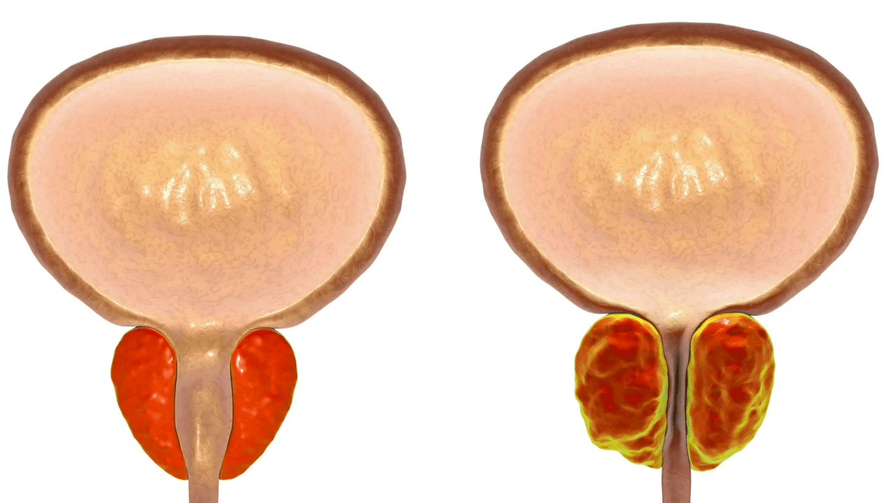 Ինչ է պրոստատիտը