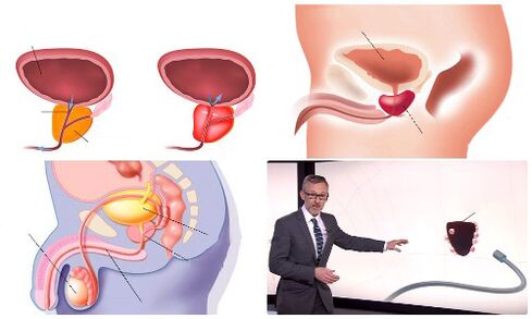 առողջ և հիվանդ շագանակագեղձ
