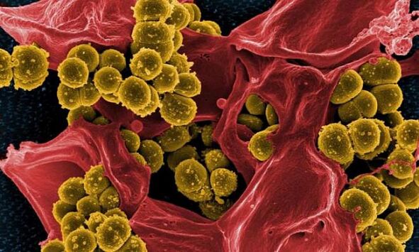 Staphylococcus aureus- ը ՝ որպես բակտերիալ պրոստատիտի պատճառ